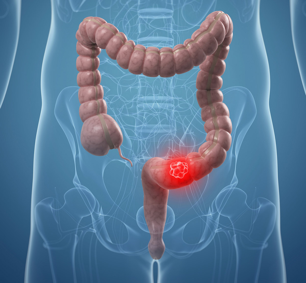 Sul Informação - Cancro colorretal – o importante é rastrear!