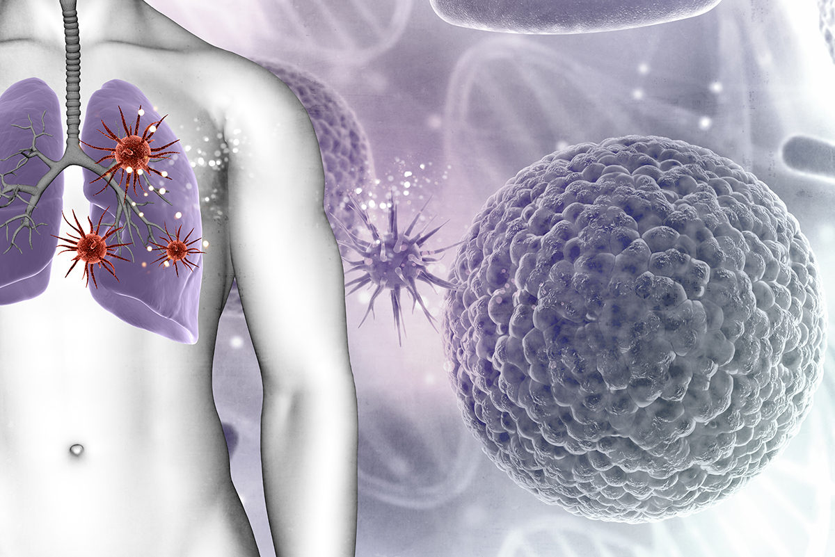 Sul Informação - Rastreio ao cancro do pulmão é urgente, diz a Associação Pulmonale