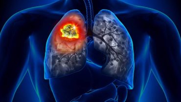 cancro do pulmao