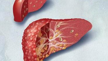 esteatose hepática|esteatose hepática