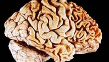 frontotemporal|Manuela Gazina
